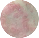 皮肤过敏影响健康